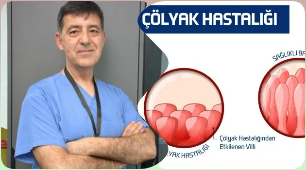 Çölyak Hastalığı Kadınlarda Daha Yaygın: Gizli Vakalar Tehlike Saçıyor